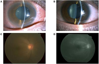 Effectiveness of Baricitinib in Refractory Seronegative Rheumatoid Arthritis and Uveitis: A Case Report